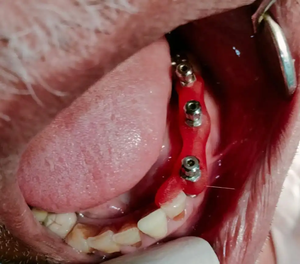 Dental implant consultation at Hyderabad Dental